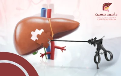 أخذ عينة من الكبد بالمنظار
