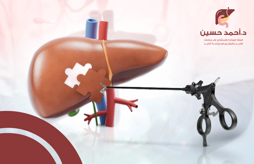 أخذ عينة من الكبد بالمنظار