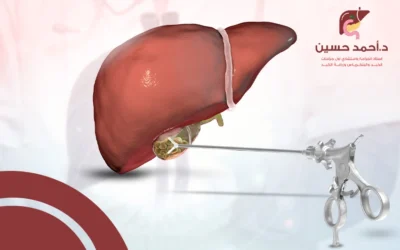 ازالة الحصوات من القناة الصفراوية بالمنظار بدون جراحة
