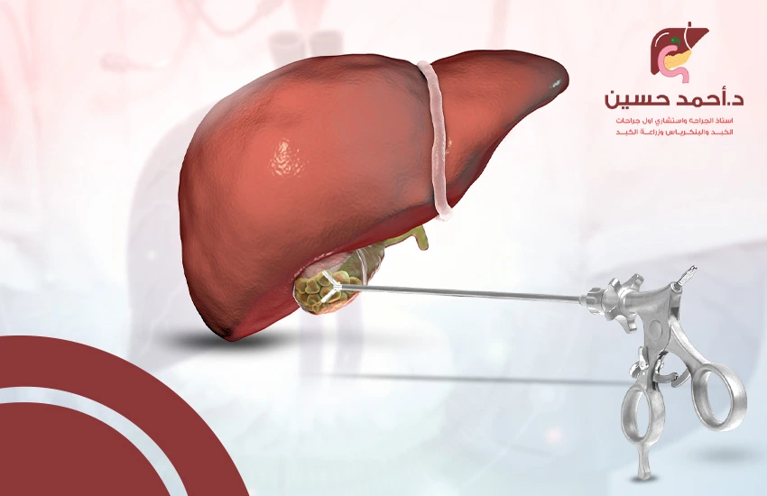 إزالة الحصوات من القناة الصفراوية بالمنظار بدون جراحة