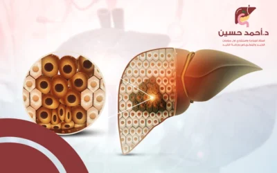 استئصال جزء من الكبد