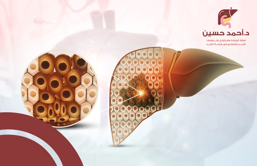 استئصال جزء من الكبد