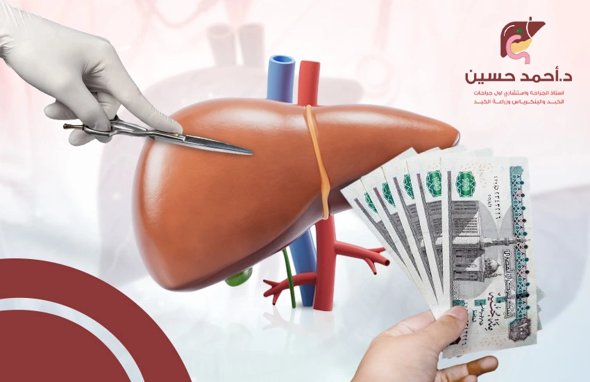 تكلفة زراعة الكبد في مصر