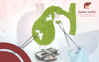 ما العوامل المؤثرة في تكلفة عملية المرارة بالجراحة؟