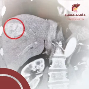 شكل ورم سرطان الكبد بالصور 1
