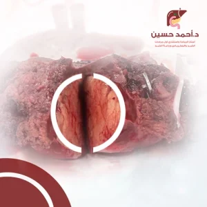 شكل ورم سرطان الكبد بالصور 2