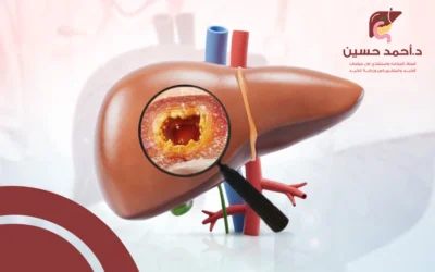 طرق علاج بؤر الكبد الحميدة والسرطانية