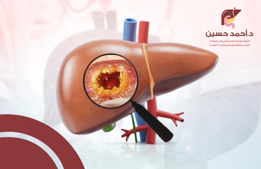 علاج بؤر الكبد