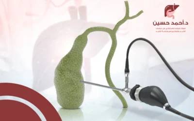 عمليات استئصال المرارة بالمنظار