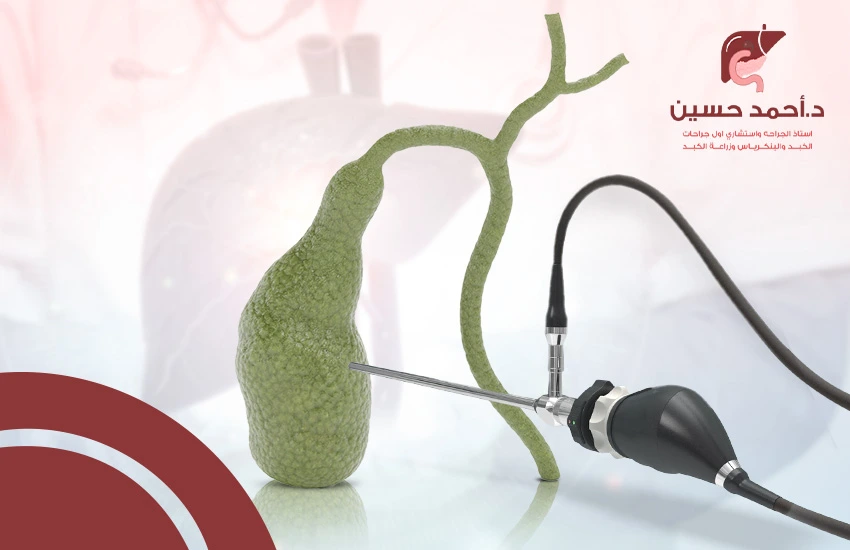 عمليات استئصال المرارة بالمنظار