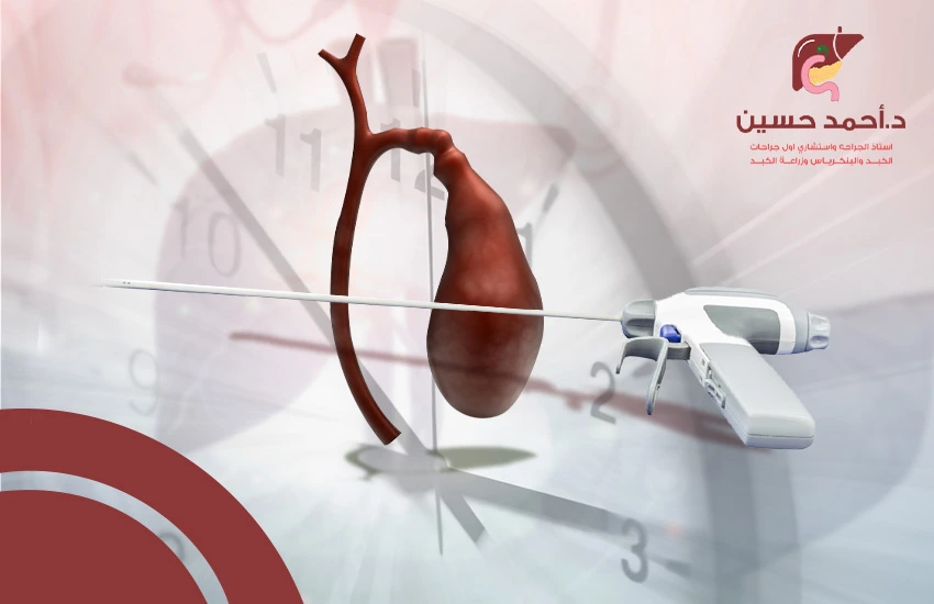 مدة عملية استئصال المرارة بالمنظار
