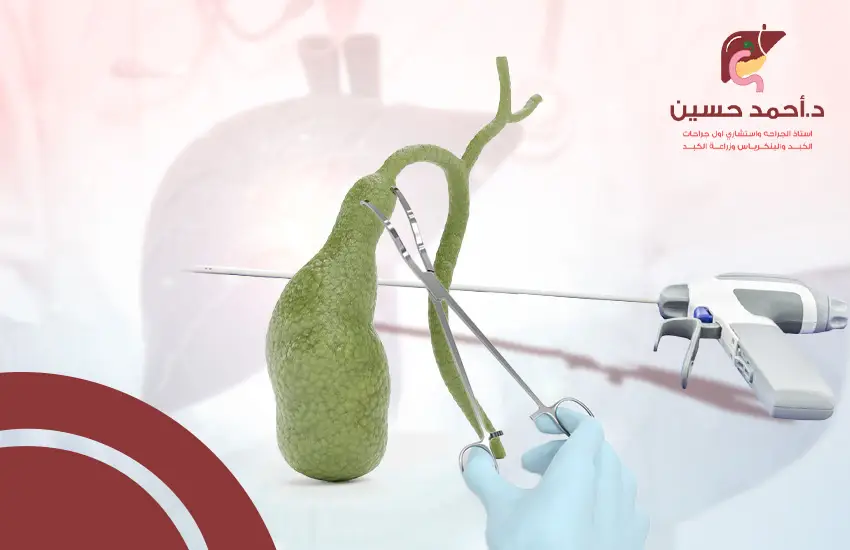 ايهما أفضل استئصال المرارة بالمنظار ام بالجراحة