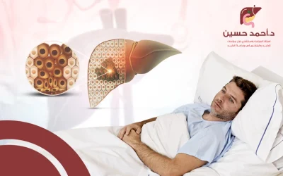 ما بعد عملية استئصال جزء من الكبد