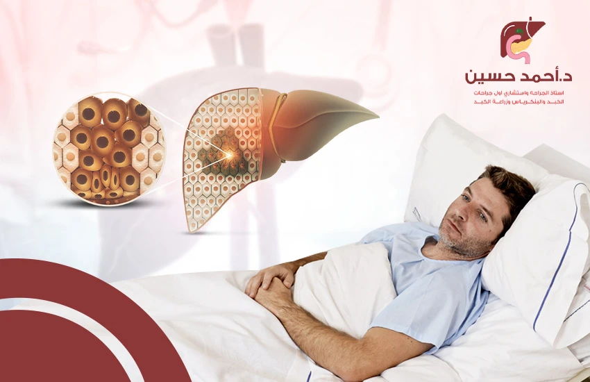 بعد عملية استئصال جزء من الكبد