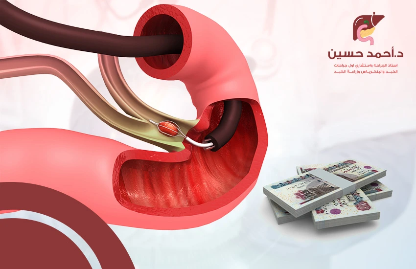 تكلفة منظار القنوات المرارية