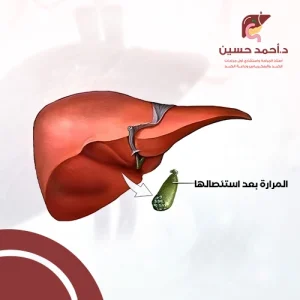 شكل المرارة بعد استئصالها