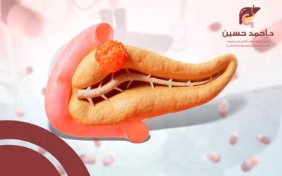 علاج ورم البنكرياس الحميد