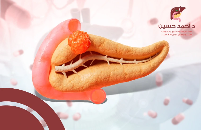 علاج ورم البنكرياس الحميد