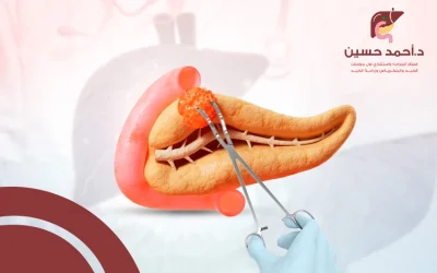 عملية استئصال ورم الاثنى عشر