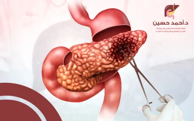 عملية استئصال ورم البنكرياس