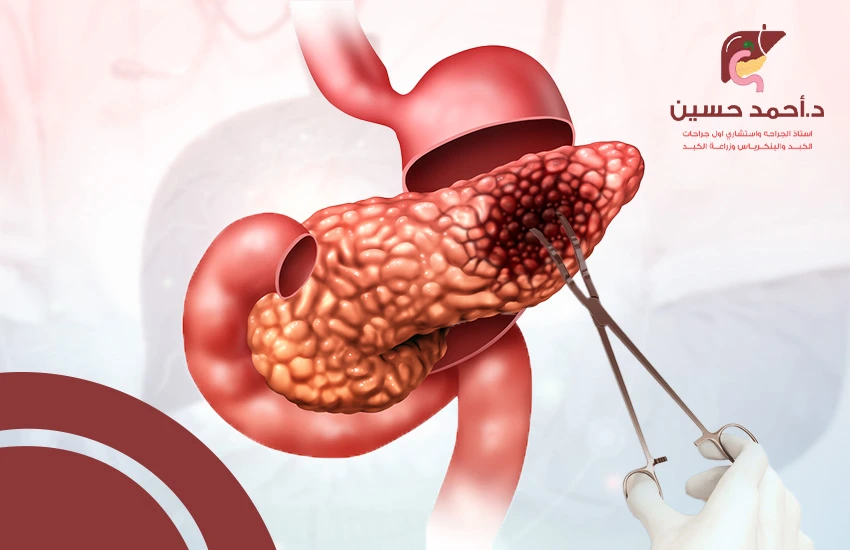 عملية استئصال ورم البنكرياس