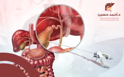 منظار القنوات المرارية