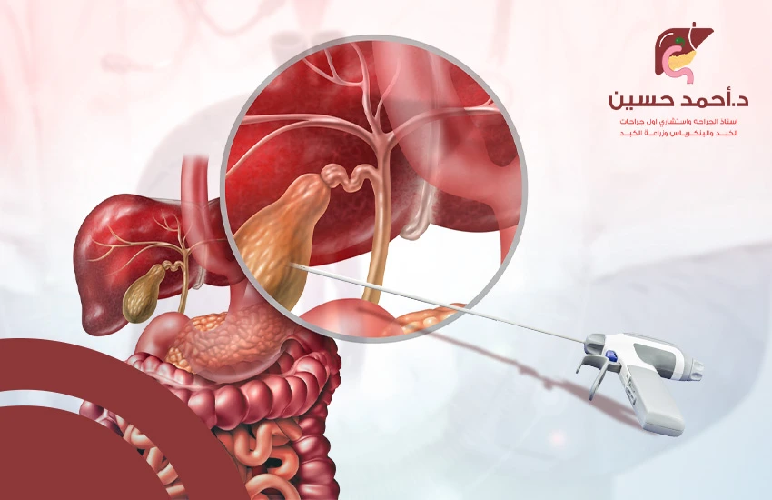 منظار القنوات المرارية