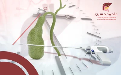وقت عملية المرارة بالمنظار: ما تحتاج معرفته قبل الإجراء وبعده