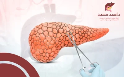 عملية استئصال البنكرياس