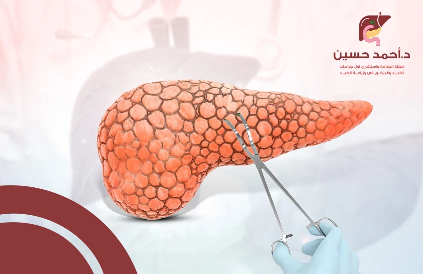 عملية استئصال البنكرياس