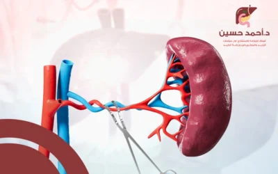 استئصال الطحال