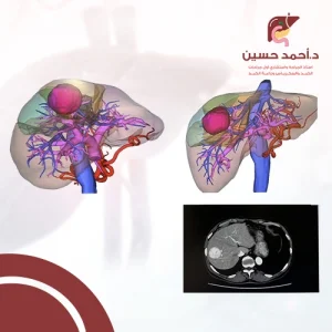 تأثير السرطان على الأوردة والشرايين في الكبد