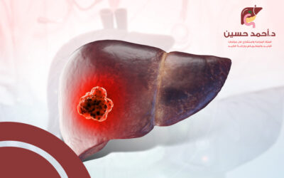 كل ما تريد معرفته عن سرطان الكبد وعلاجه