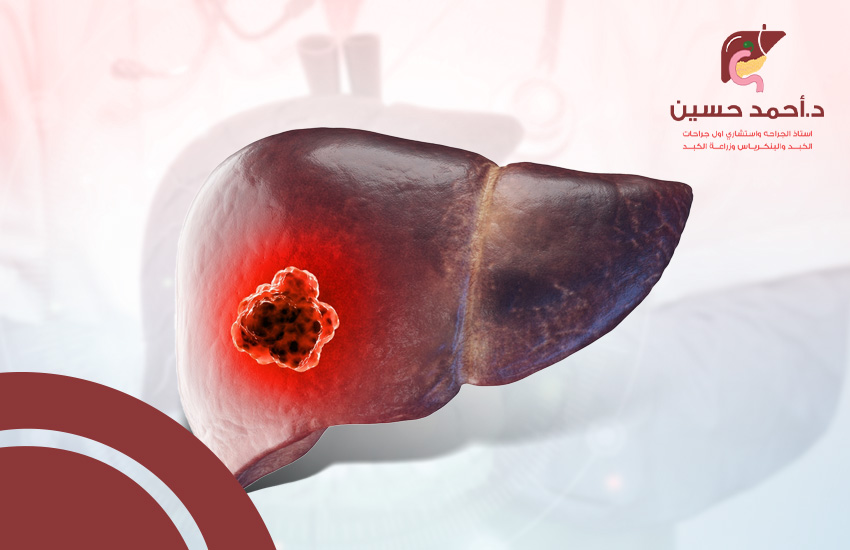 سرطان الكبد وعلاجه