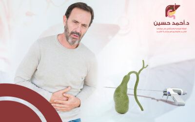 كيف أتغلب على عيوب استئصال المرارة بالمنظار؟
