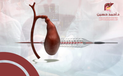 عمليات تركيب دعامة في القنوات المرارية | دواعي إجرائها وخطواتها