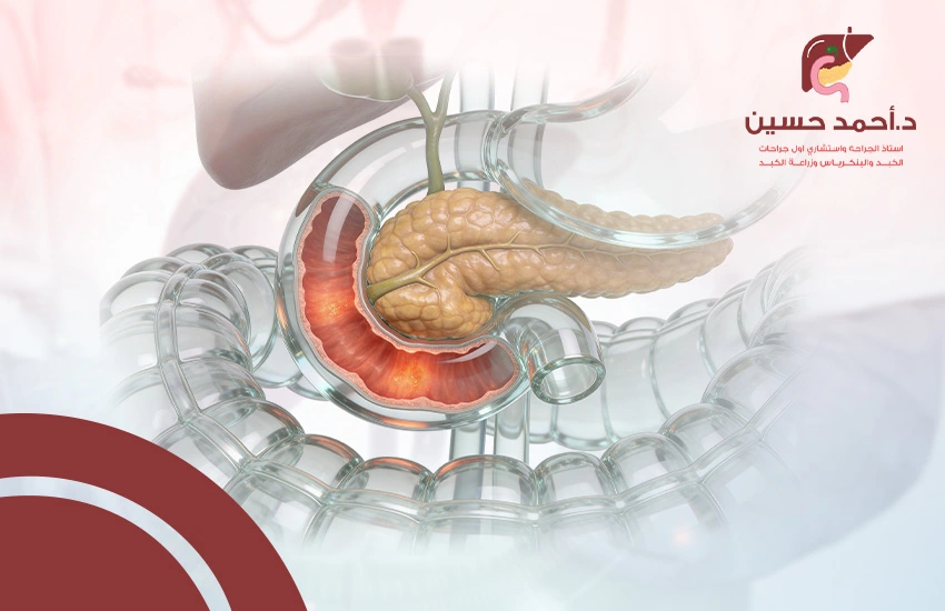 التهاب-الاثنى-عشر التهاب الاثنى عشر